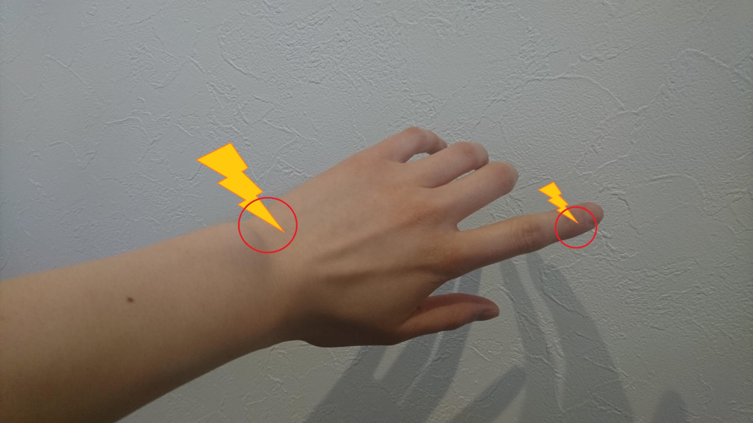 指の捻挫はどのように治療されますか?