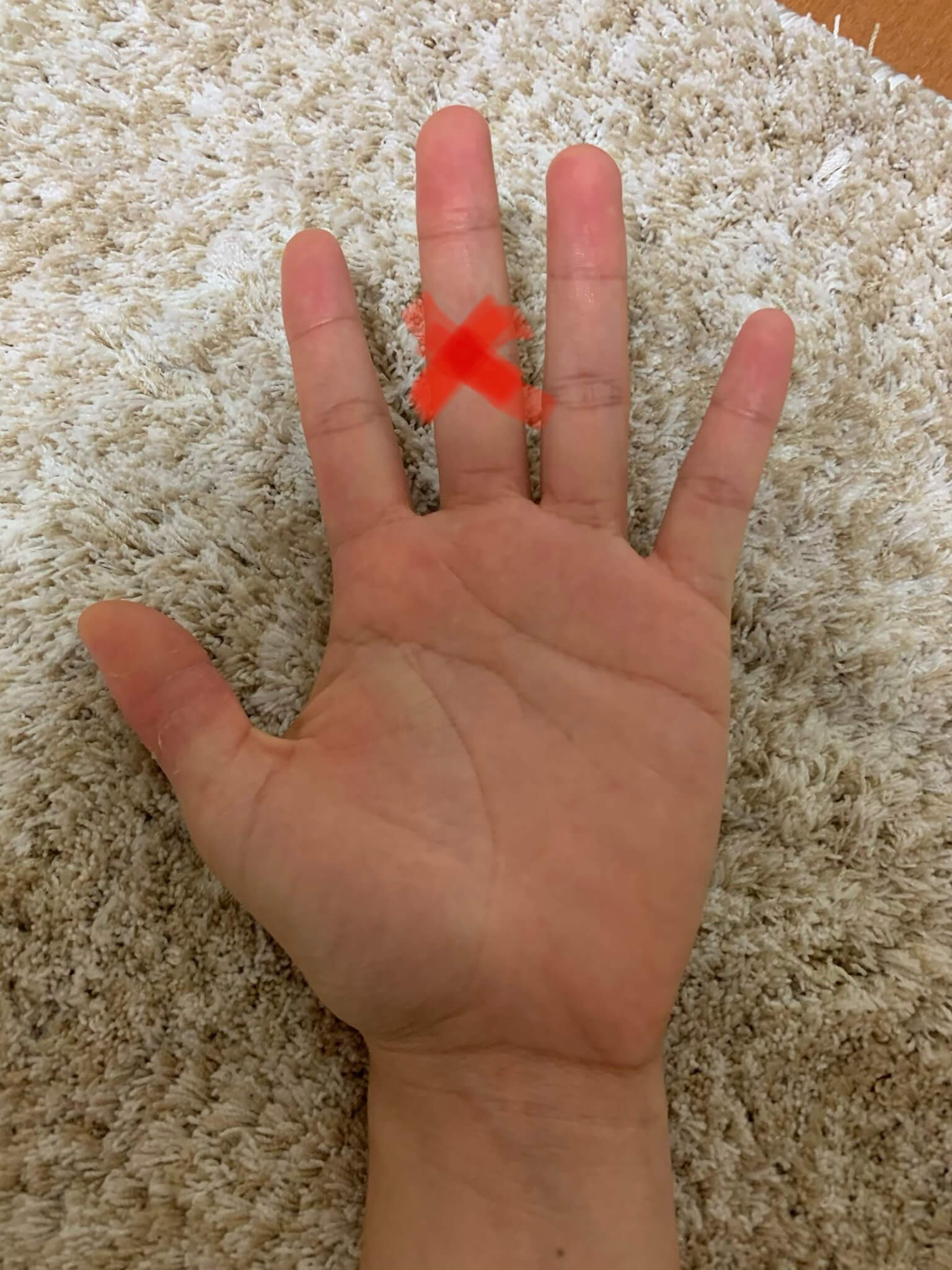 突き指 と 骨折 の 違い