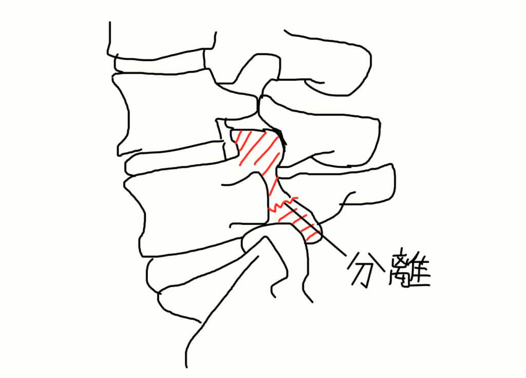 スポーツでの腰痛。腰椎分離症かもしれません。 天寿堂整骨院・天寿堂鍼灸マッサージ院公式ブログ